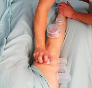 cupping therapy massage portland oregon