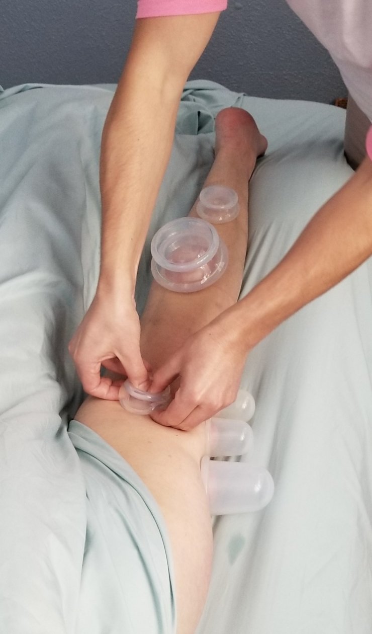 Cupping Massage Portland Oregon. Best Cupping Massage